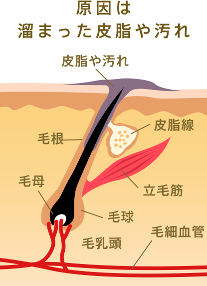 ニキビの画像